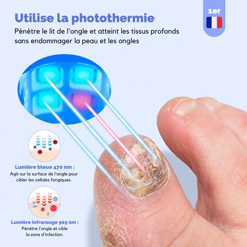 Laser Anti-Mycoses des Ongles