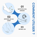 Laser Anti-Mycoses des Ongles